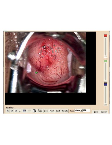 COLPOSCOPY SOFTWARE for 29620, 29600 with 29603